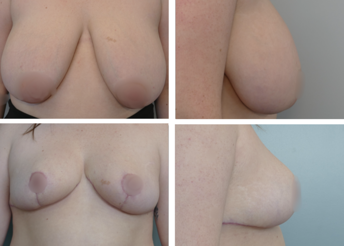 Breast Lift Portland Before and After by Dr. Tina Jenq